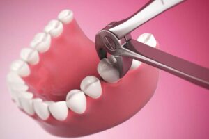 7 Different Types of Oral Surgery Procedures - Hampton Village Dentistry