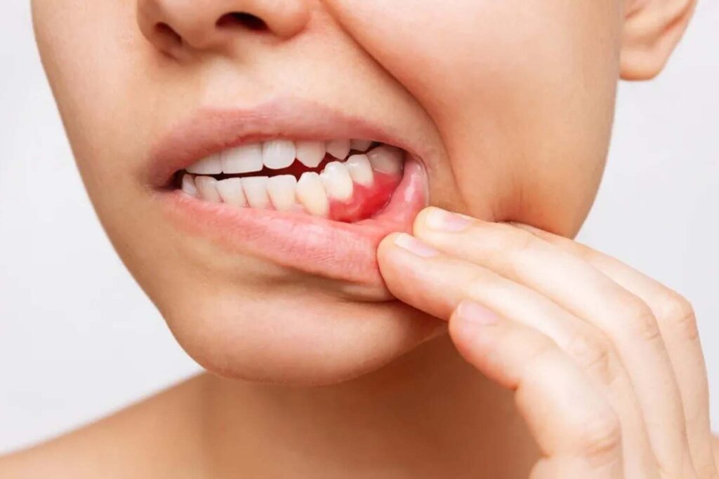 Gum Inflammation and Irritation