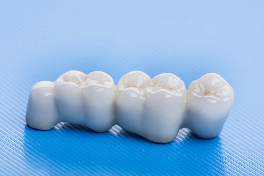 dental bridge regularly for any visible gaps or shifting